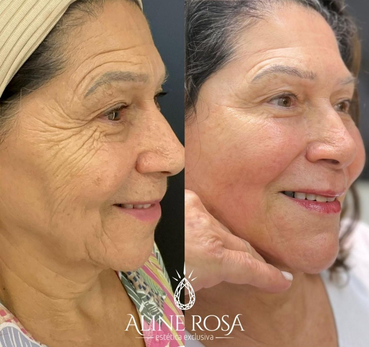 Estruturação Facial com Fios Coreanos